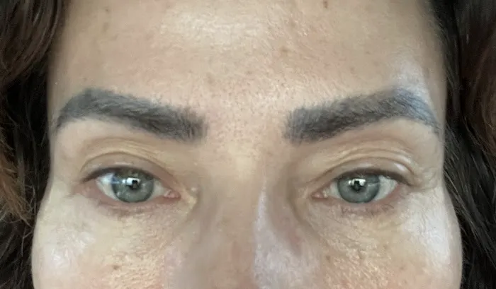 Removery Tattoo Removal & Fading 0