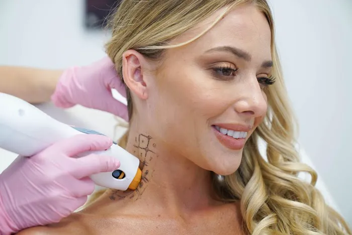 LaserAway Oxnard 5