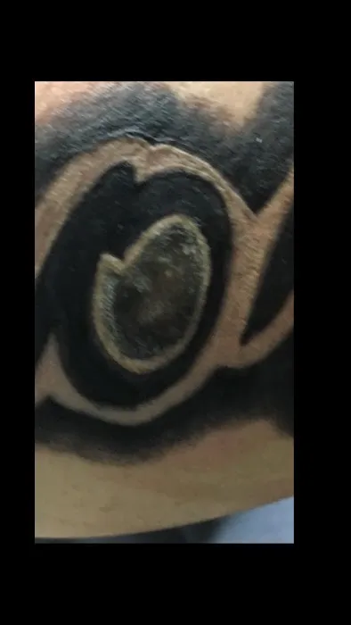 Goawaytats tattoo removal 1