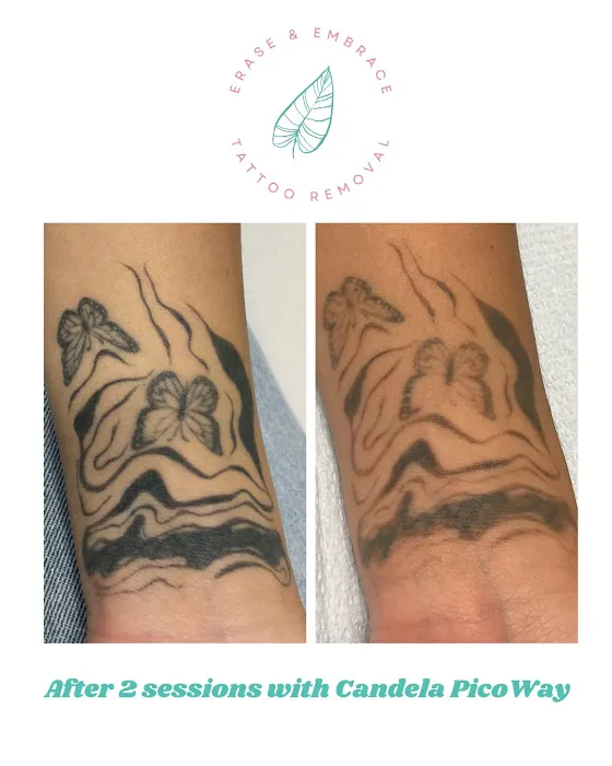 Erase & Embrace Tattoo Removal 0
