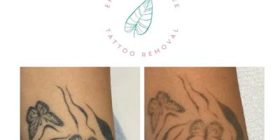 Erase & Embrace Tattoo Removal