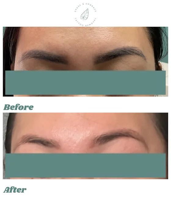 Erase & Embrace Tattoo Removal 8