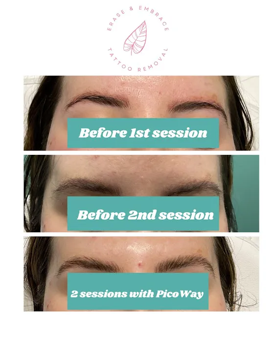 Erase & Embrace Tattoo Removal 5