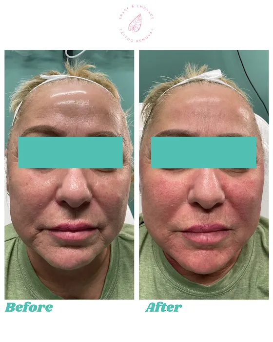 Erase & Embrace Tattoo Removal 9