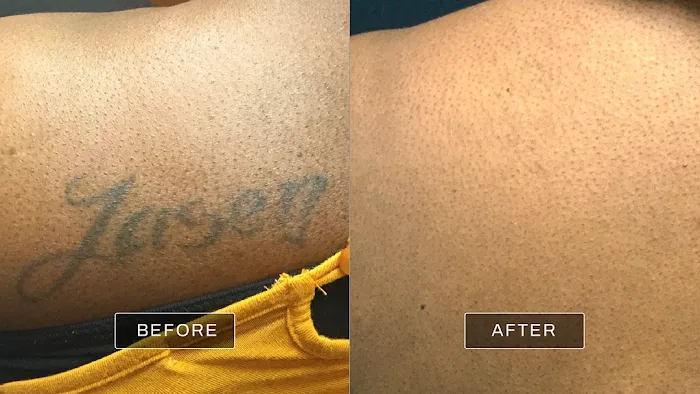 Removery Tattoo Removal & Fading 5
