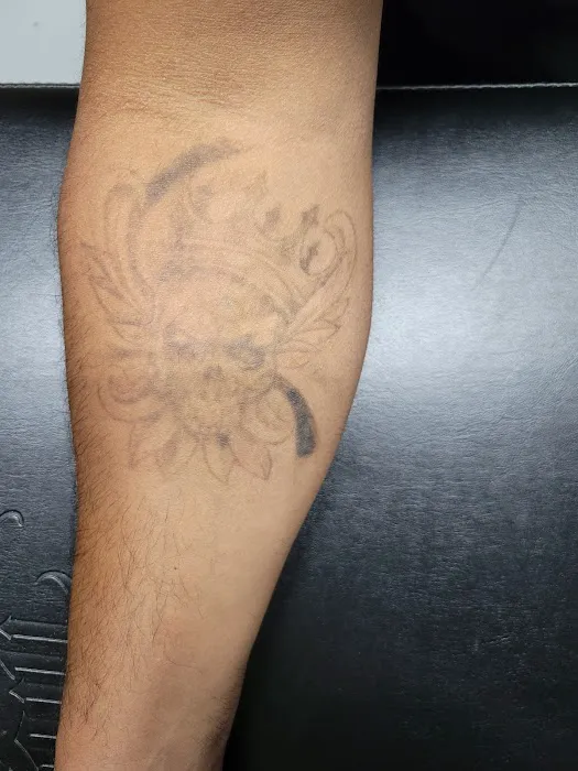 Black Out Tattoo Removal 2