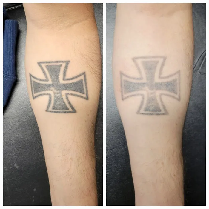 Black Out Tattoo Removal 5