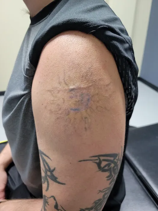 Black Out Tattoo Removal 0