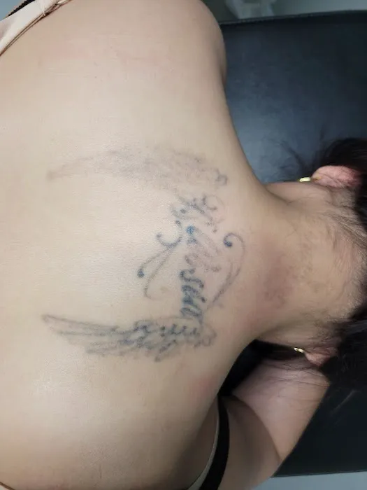 Black Out Tattoo Removal 4
