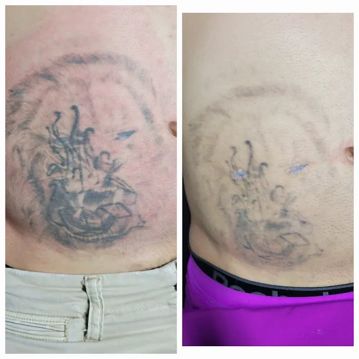 Black Out Tattoo Removal 3